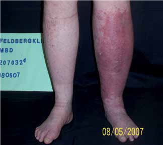 tratament cu erizipelă deformarea artrozei simptomelor articulațiilor genunchiului